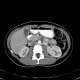 Circumaortic renal vein: CT - Computed tomography